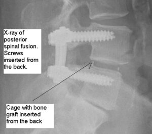 An x-ray of posterior lumbar interbody fusion